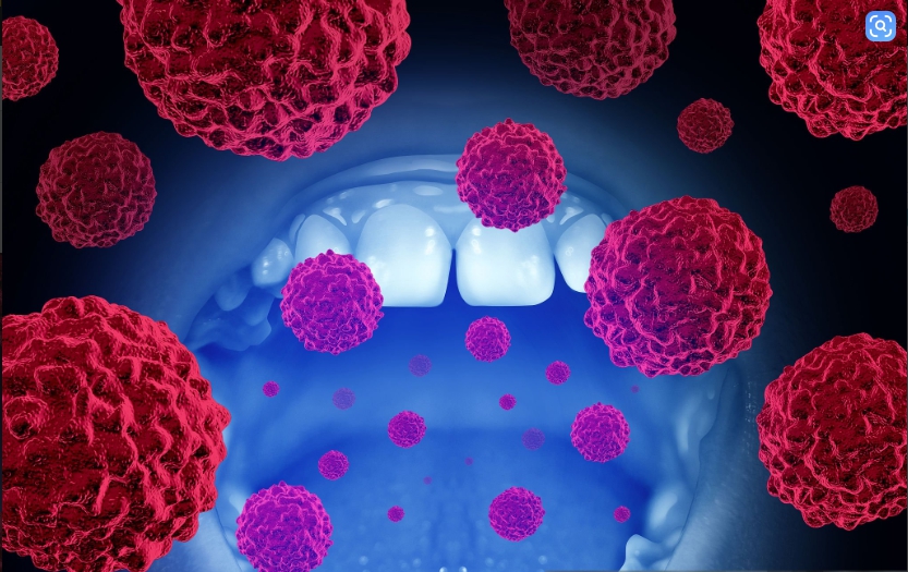 구강암 관련 사진
