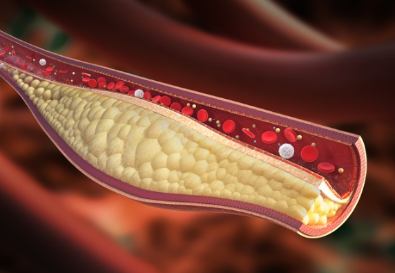 콜레스테롤 낮추는 방법