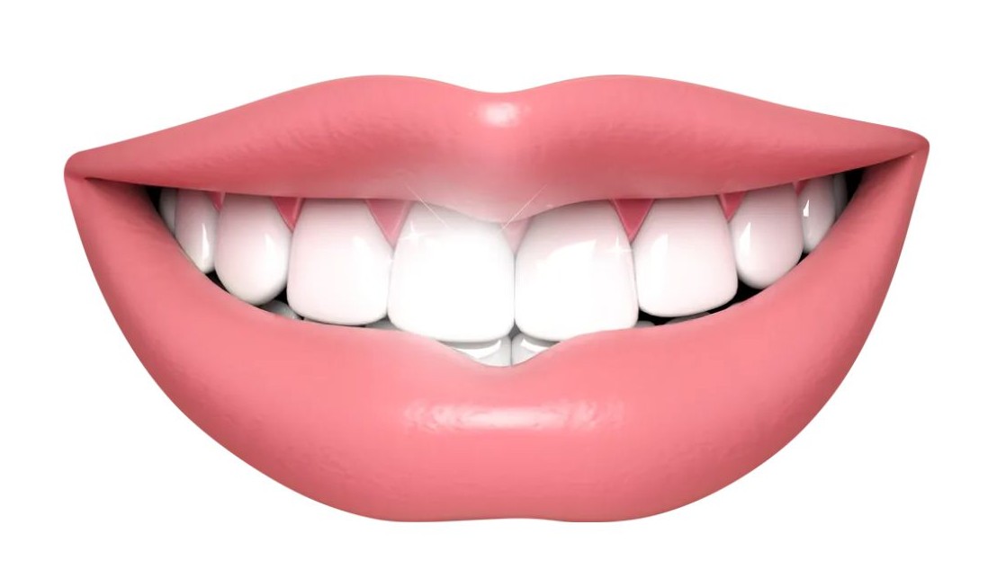 이빨 깨지는 꿈