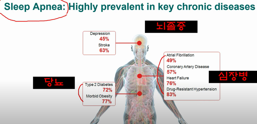 코골이와 수면무호흡으로인한 질환 참조 논문 이미지