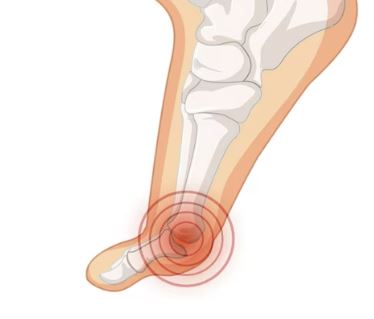 통풍 빨리 낫는 방법