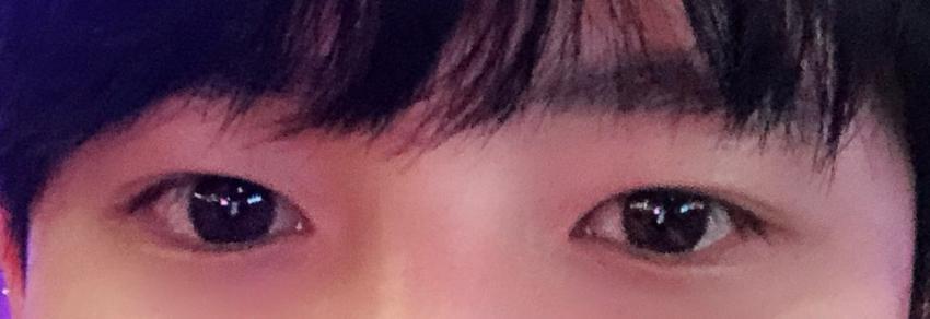안검하수 후기