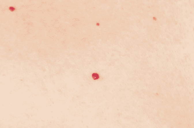 체리혈관종 중년