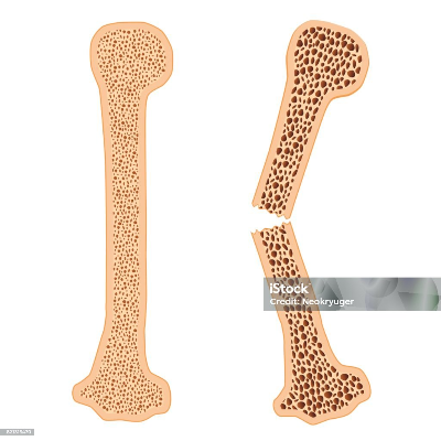 정상일때 사진과 골다공증으로 뼈가 구멍이 커진 상태