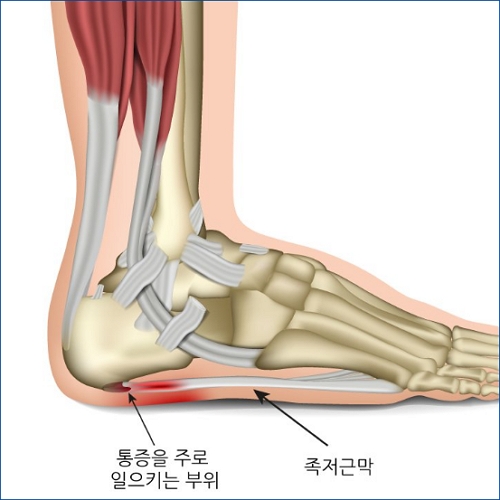 발뒤꿈치 패드