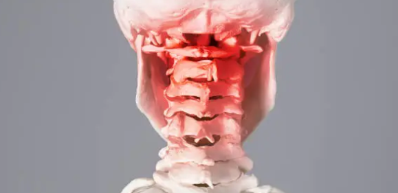 경추협착증과 관련된 사진