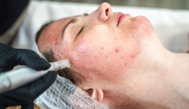 여드름 필러 시술