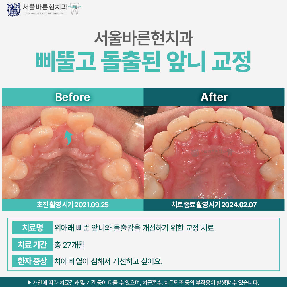 부산치아교정