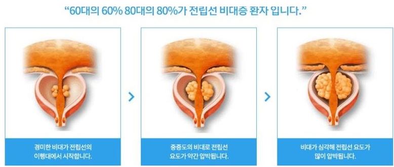 쏘팔메토추천