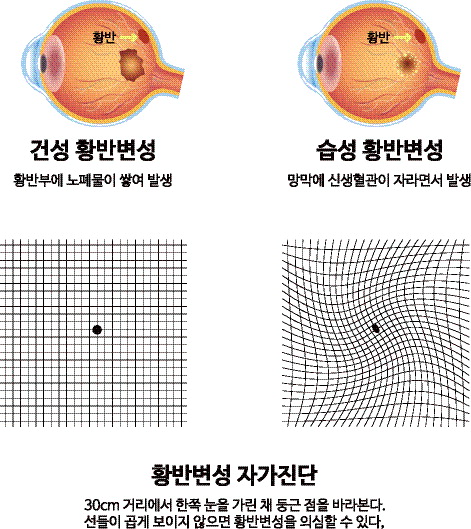 황반변성 증상, 황반변성 치료법, 원인