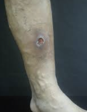 하지 정맥류 증상 33