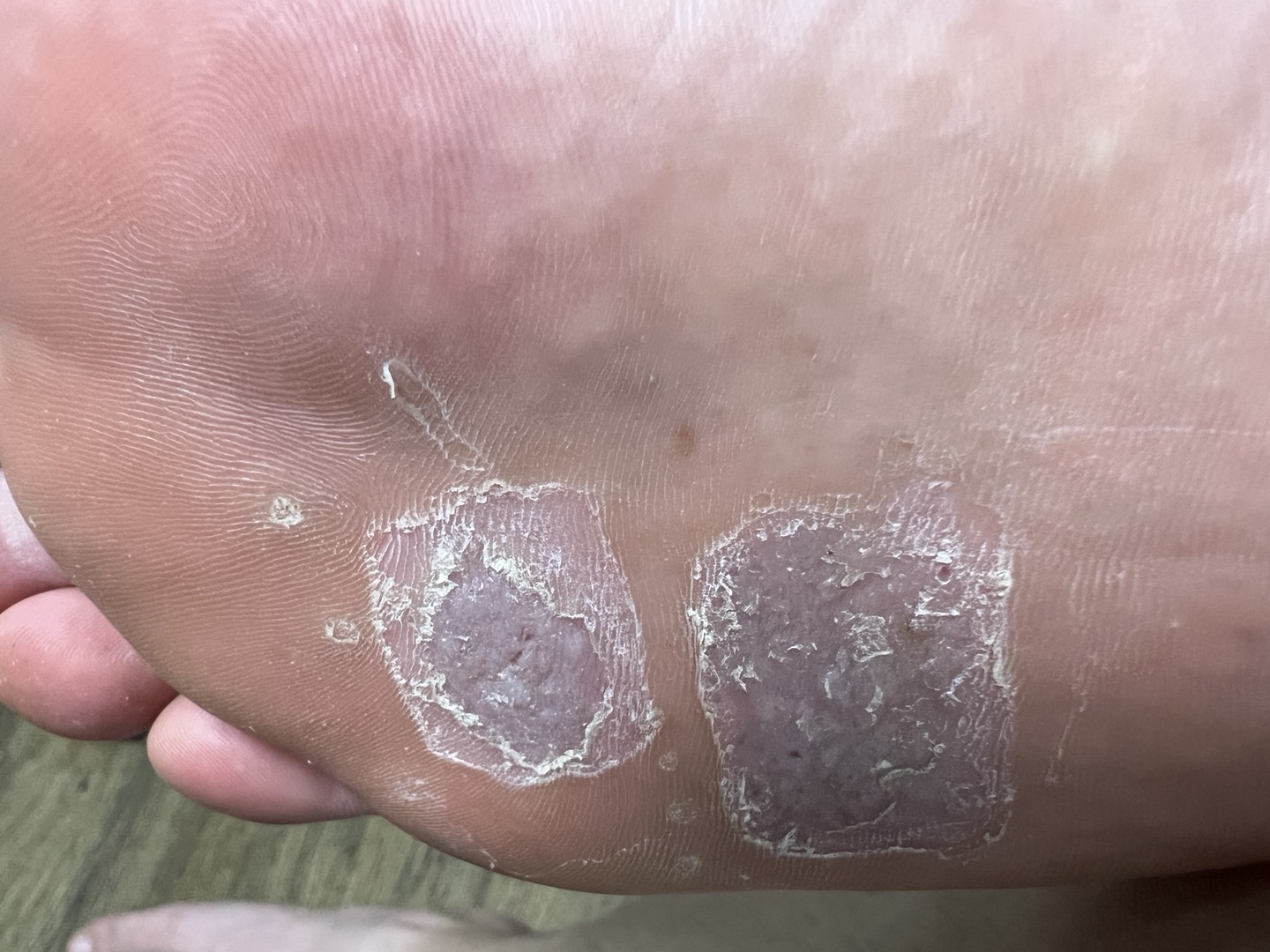 발바닥 사마귀 냉동치료과정