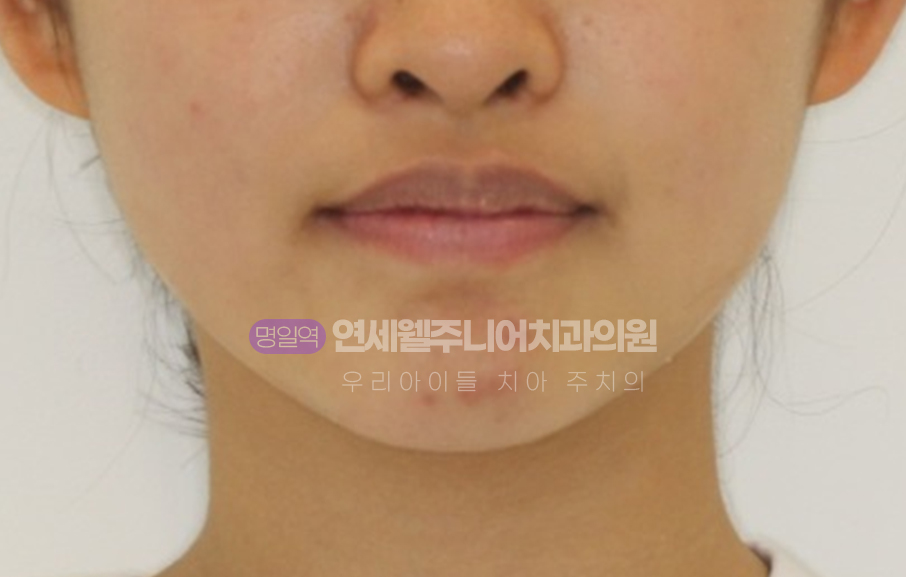 중학생 치아교정 진단을 위한 입술과 턱의 정면 안모 사진