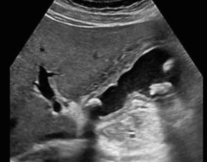 급성 담낭염 (Acute cholecystitis)
