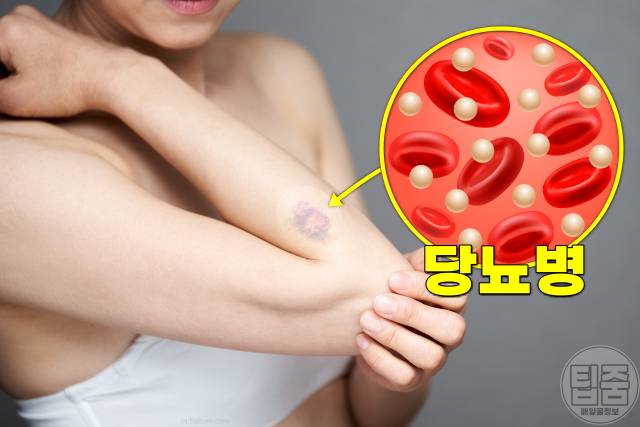 팔 다리 멍 자주 생기는 이유 멍원인 혈당