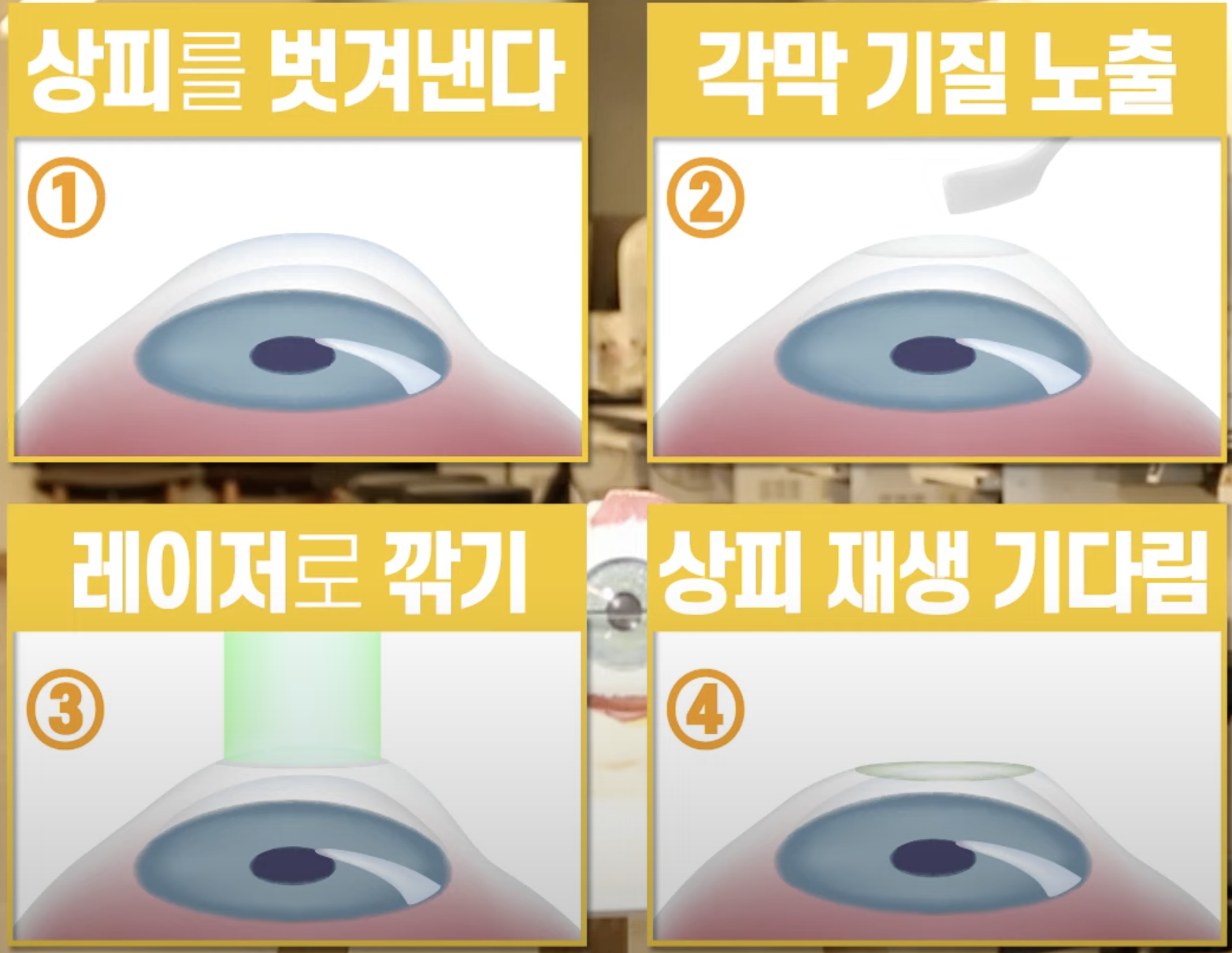 시력교정술 종류 라섹 라식 스마일 장단점 비교