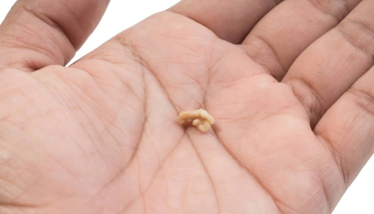 편도결석 자연치유 방법