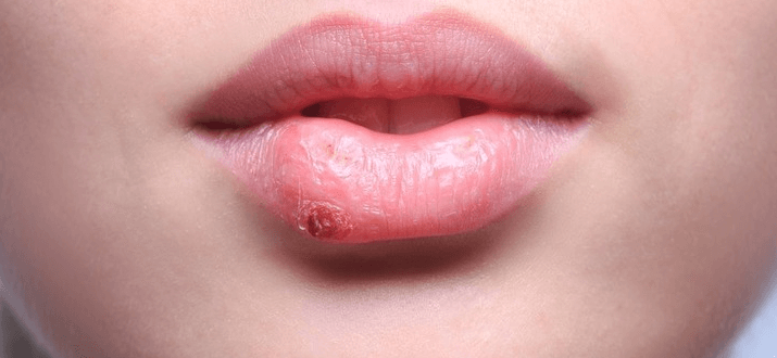 입술 상처