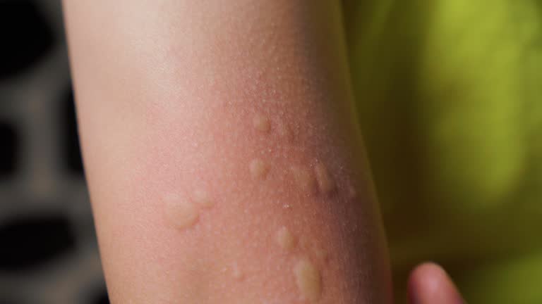 한랭두드러기 찬바람만 스쳐도 올라오는 붉은 반점