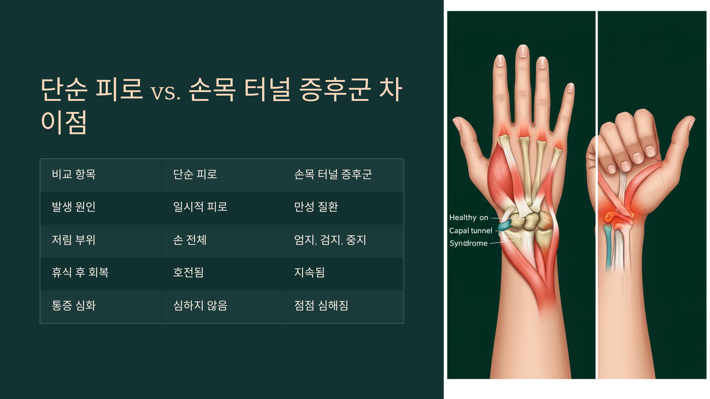 단순 피로 vs 손목 터널 증후군 차이점