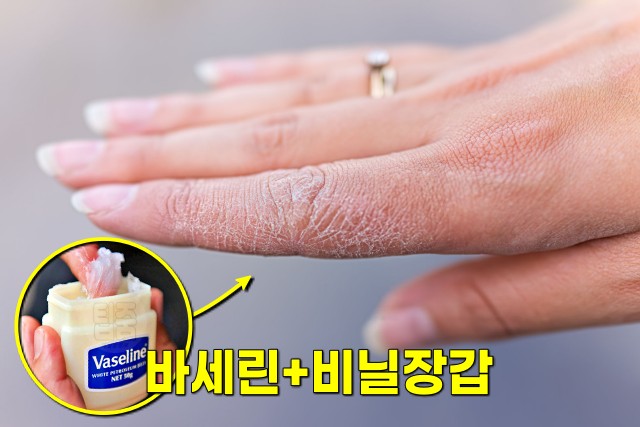 손이 갈라지고 벗겨져요 바세린 비닐장갑 피부 건조증 예방 치료법, 팁줌