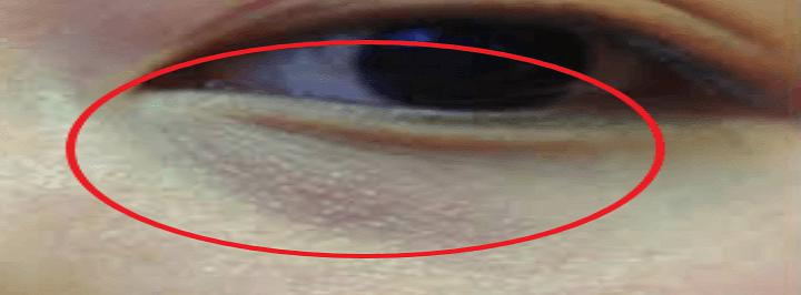 눈밑꺼짐 없애는 방법 대표사진