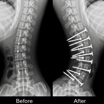 척추 측만증 검사 방법과 병원 선택17