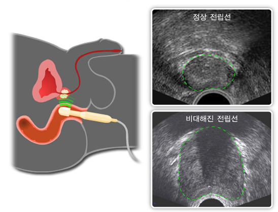 전립선비대증-초음파-검사