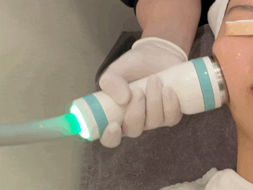 온다 리프팅 후기