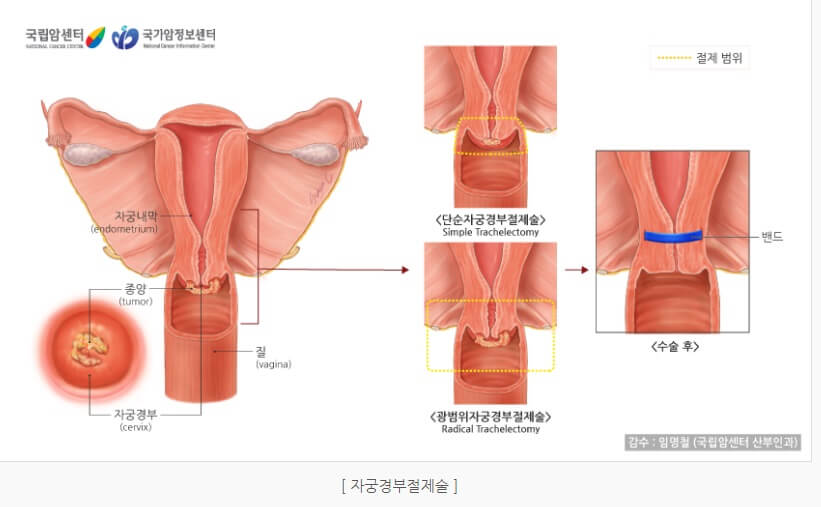 자궁경부암 수술방법