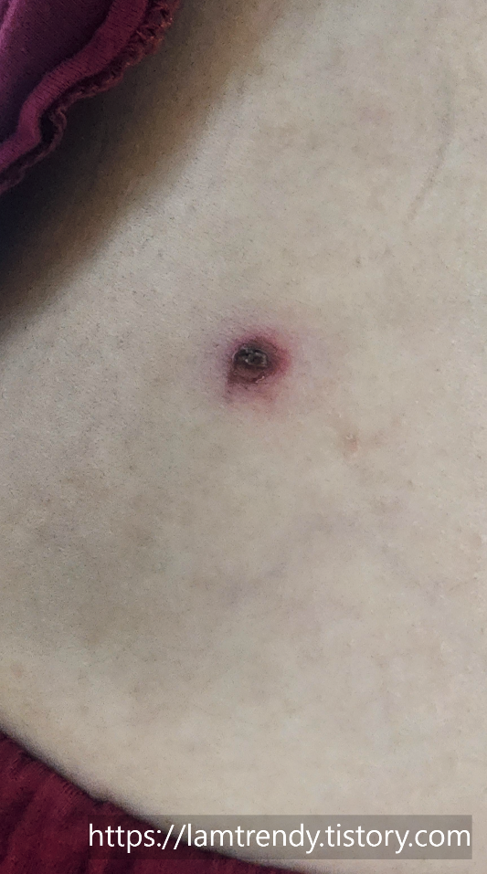 쥐젖 냉동치료후 일주일