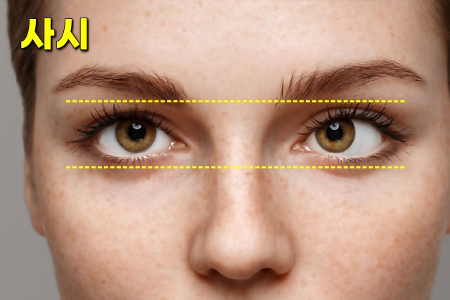 옆으로 누워서 스마트폰, 짝눈 시력 눈매 교정, 사시 부동시 원인