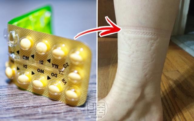 다리 양말자국 질환 코끼리다리 무다리 원인 피임약 부작용