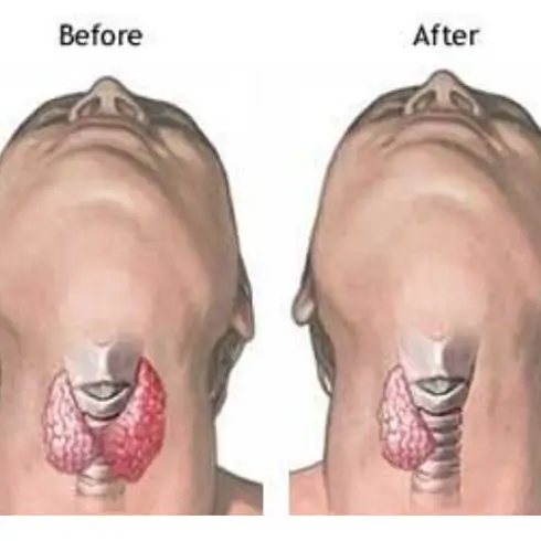 갑상선암 수술비용