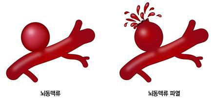 뇌동맥류 원인