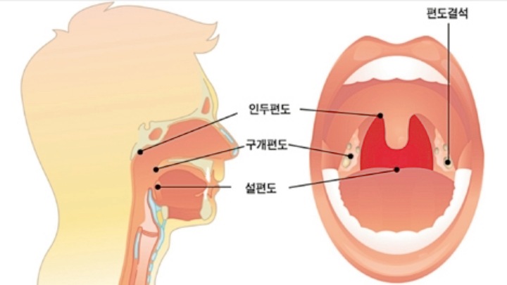 편도결석