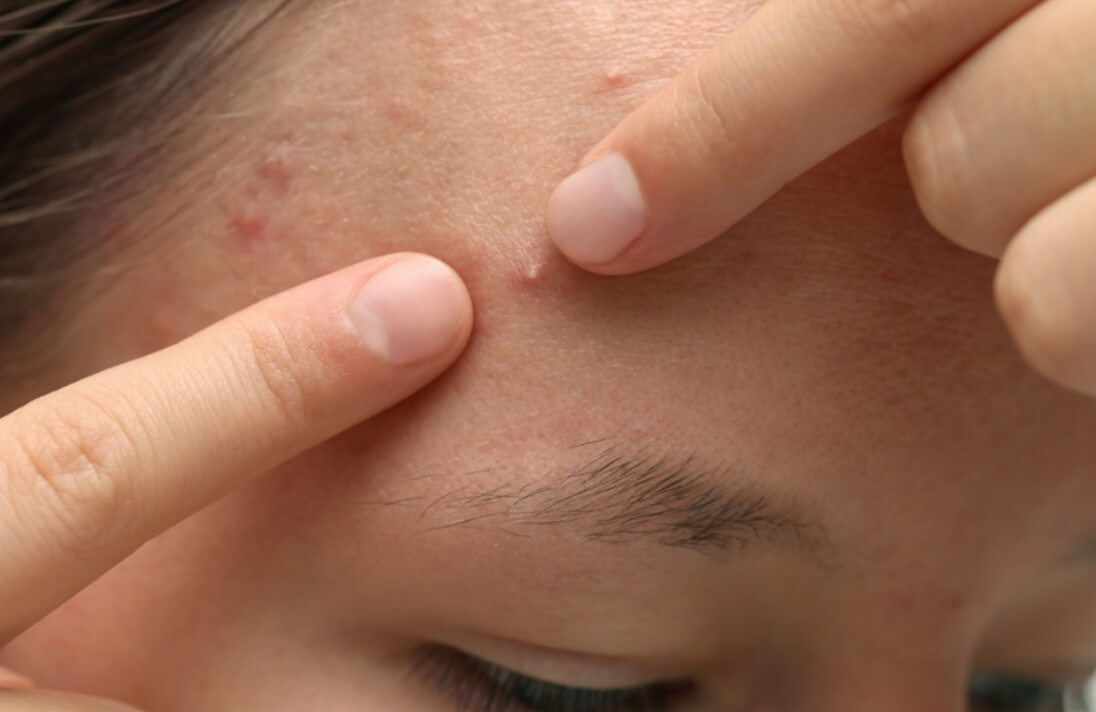 여드름을 짜는 모습