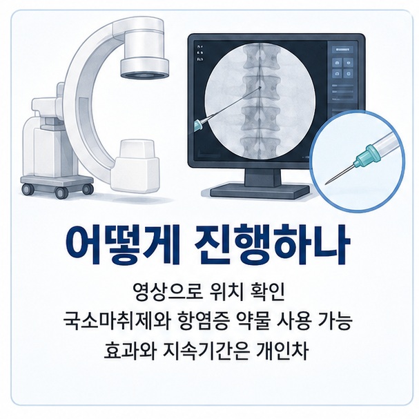 엑스선 투시장비나 초음파로 목표 신경의 위치를 확인한 뒤 약물을 주입하며 시술 효과와 지속기간에는 개인차가 있음을 보여 주는 그림