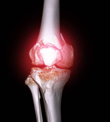 내측 인대 손상