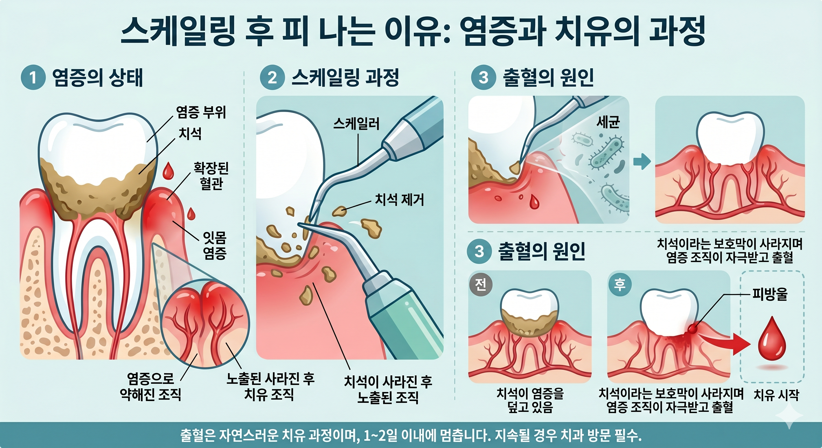 스케일링 후 피 나는 이유를 설명하는 잇몸과 치석 이미지