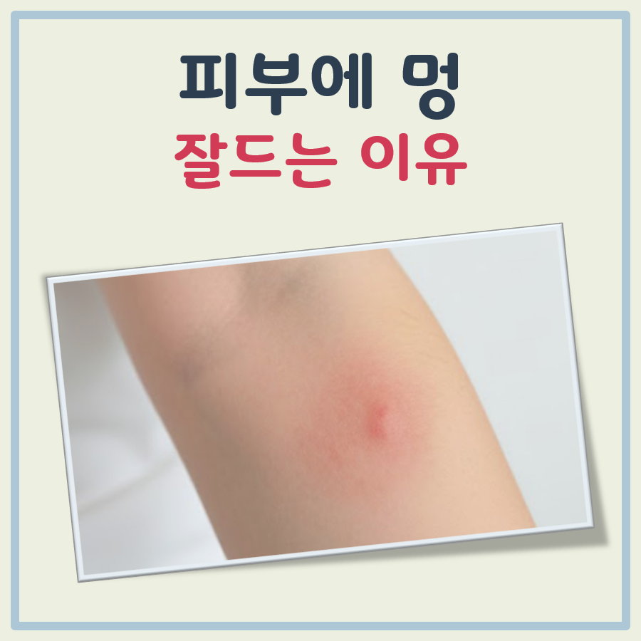 피부에 멍이 잘드는 이유 대표 이미지