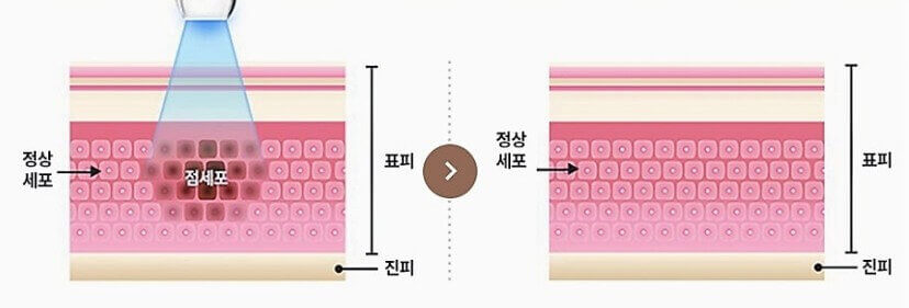 쥐젖 피부 단면 설명