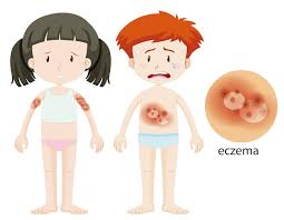 피부발진의 종류