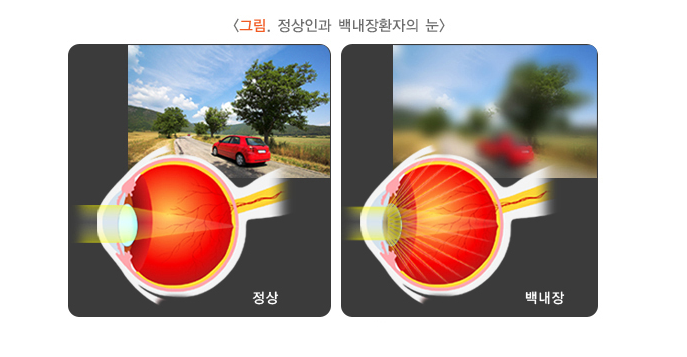 정상인과 백내장환자의 눈 차이