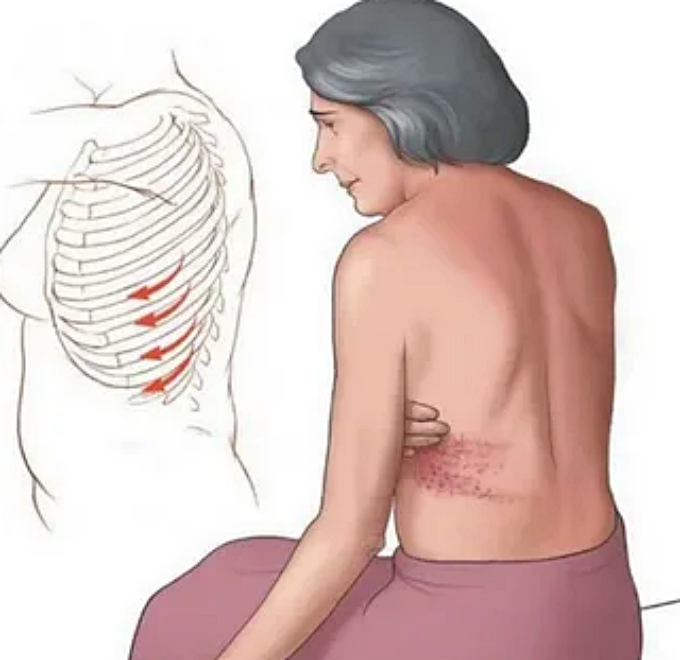 대상포진 예방접종 부작용 및 가격 : 접종 1회면 되나요, 유효기간