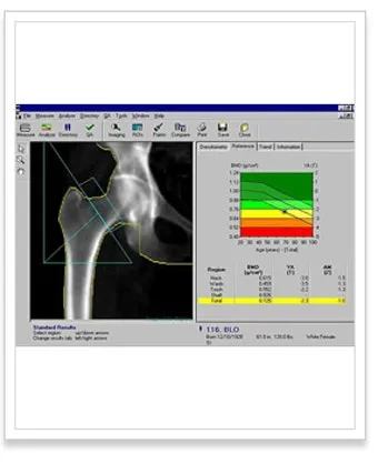 골밀도 검사 수치 골밀도 높이는 방법 간단 정리_11