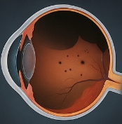 망막 박리 증상