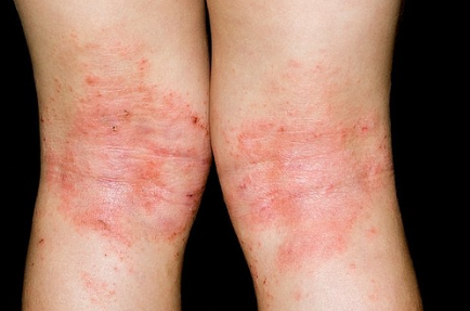 겨울철 아토피 관리법