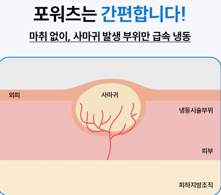 냉동치료기