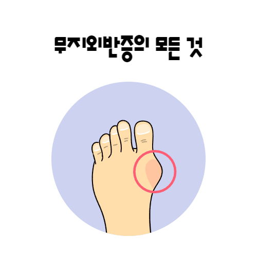 무지외반증-증상-원인-치료방법